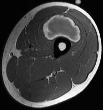 Figure 3 for case vastus intermedius intramuscular hematoma ( RID2702 )